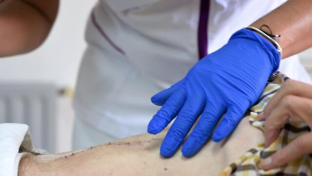 Nurse removing surgical stitches from the abdomen of a patient following surgical intervention. High quality 4k video.