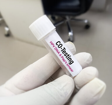 Vaginal fluid sample for CO-Testing (HPV DNA test and Paps smear test), Human papilloma virus, cervical cancer. A medical testing concept in the laboratory