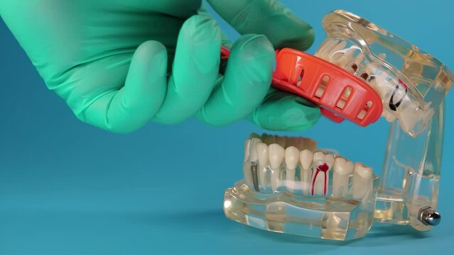 The hand of an orthodontist doctor makes an impression of a dental jaw on a mock-up on a blue background. The concept of making crowns and artificial jaws in dentistry, close-up. Slow motion, copy
