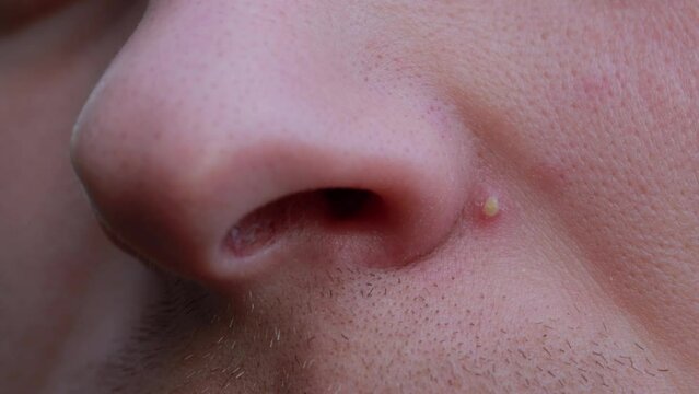 A white pimple on a man's face near his nose. Dirty skin, black pores, dermatology, macro. Healthcare and medicine