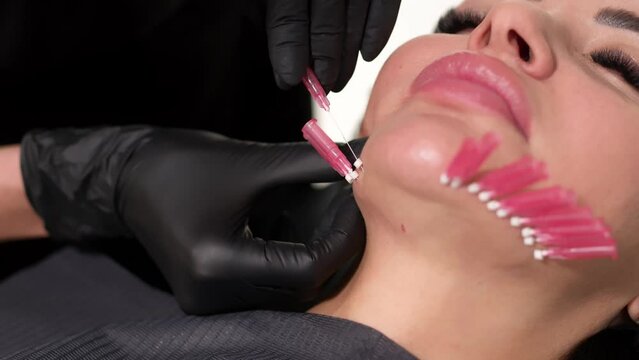 Thread lifting is a cosmetic facial rejuvenation procedure. A cosmetologist implants cosmetic threads under the skin for face lifting and rejuvenation in a modern clinic.