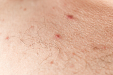 Macro shot of red pimples on a human skin, acne disease, dermatology problem