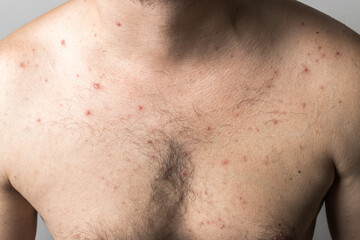 Naked man with red pimples on his chest, acne skin disease, dermatology problem