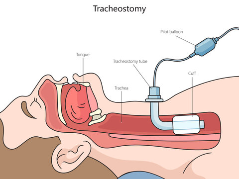 Tracheotomy tube structure vertebral column diagram hand drawn schematic vector illustration. Medical science educational illustration