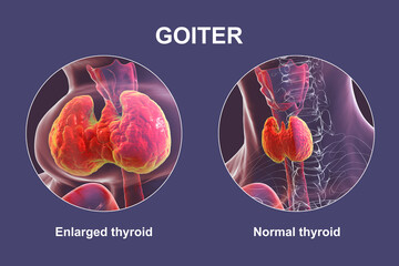 Enlarged thyroid gland, 3D illustration - obrazy, fototapety, plakaty