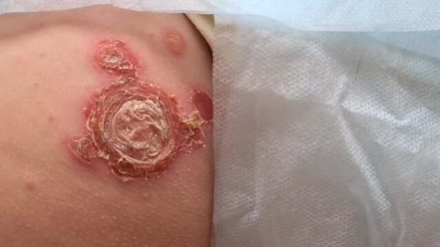 Skin psoriasis is an autoimmune disease that affects skin and causes inflammation of skin