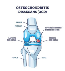 Osteochondritis dissecans or OCD bone and cartilage condition outline diagram. Labeled educational scheme with meniscus and leg bone orthopedics problem from chronic overuse vector illustration.