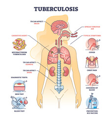Key aspects of tuberculosis or TB bacterial lung illness outline diagram. Labeled educational scheme with respiratory disease with cough, chest pain and coughing up blood symptoms vector illustration - obrazy, fototapety, plakaty