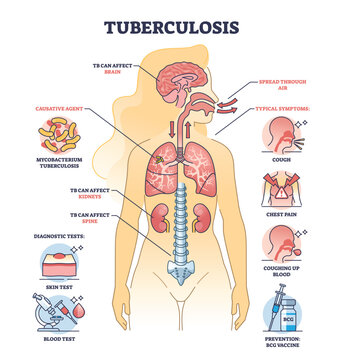 Key aspects of tuberculosis or TB bacterial lung illness outline diagram. Labeled educational scheme with respiratory disease with cough, chest pain and coughing up blood symptoms vector illustration