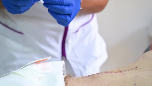 Close up of nurse's hand cleans and treats abdomen injury after surgery at the hospital. Surgical wound on the abdomen. High quality 4k footage