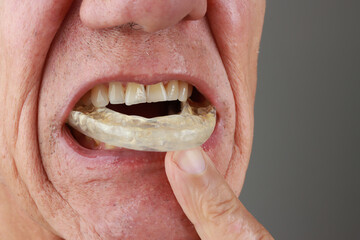 Older Mature Man putting in a night Guard in his mouth to prevent grinding