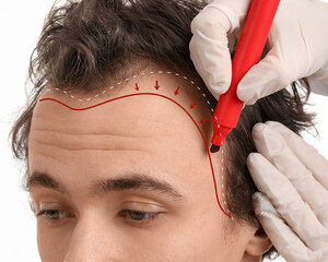 Doctor marking forehead of young man with hair loss problem on white background, closeup