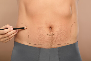 Doctor with pencil preparing patient for cosmetic surgery operation on light brown background,...