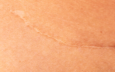 Scar on human skin after caesarean section