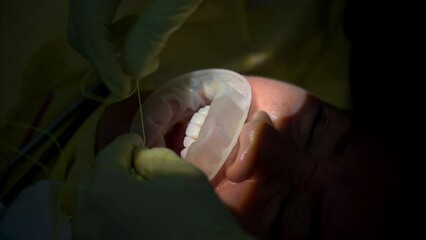 Slow motion vertical shot of a dentist wearing green latex gloves cleaning and flossing the patient's teeth after installing a set of composite veneers - Powered by Adobe