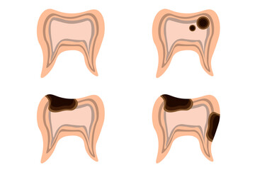 Set of Teeth in trendy cut out paper style isolated white. Collection 3d healthy and diseased teeth. Dental decay. Vector illustration can used web icon, social media poster for dental clinic.