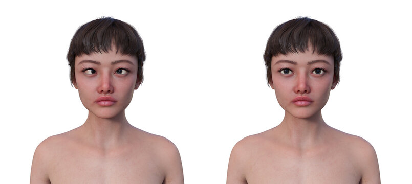 A woman with esotropia and a healthy woman, 3D illustration