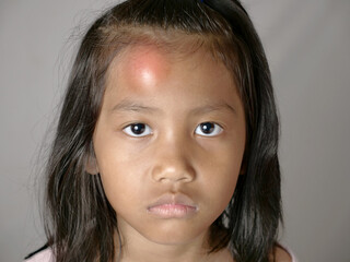 Little Asian girl with swollen bump on her forehead