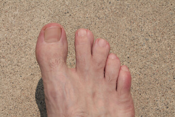 syndactyly between long second toe and middle third toe on adult male foot on pavement
