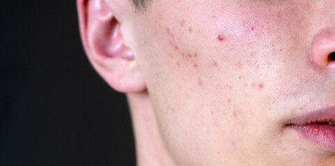 Man with pimples on skin. Acne and pimple on skin. Dermatology, puberty man. Pimples problem. Young Man with Pimple on face. Care skin, Pimples problem. Guy Pimple face, close up.