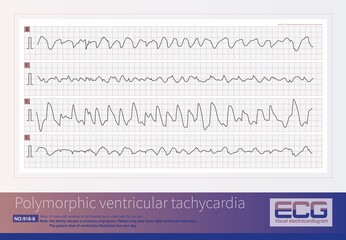 Male, 84 years old, admitted to hospital with chest pain for 1 day. ECG showed acute inferior and posterior MI and possibly right MI. The patient died of ventricular fibrillation the next day. - obrazy, fototapety, plakaty