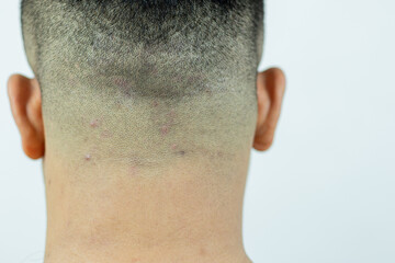 Close-up view of ringworm (tinea) on the head of an Asian man (Dermatitis). Red spots appear, itchy...