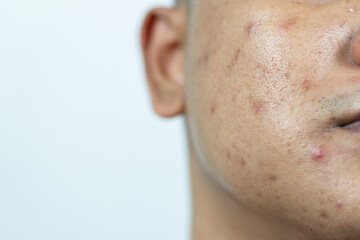 skin problems. problem of inflamed acne on the face. Inflamed acne consists of swelling, redness,...