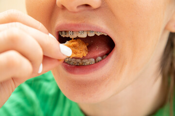 Closeup of woman in dental braces eating chicken fillet - obrazy, fototapety, plakaty