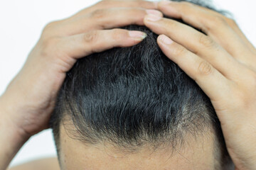 Close Up Young people have problems with hair loss, dryness, dullness, split ends and damage.