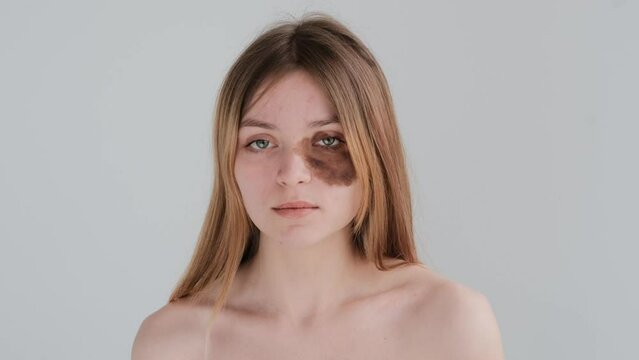 Portrait of young teenage woman with a large birthmark on her face looking at camera with gray-green eyes in peach beige colors shows hands sign to look ahead with loose tousled hair white background