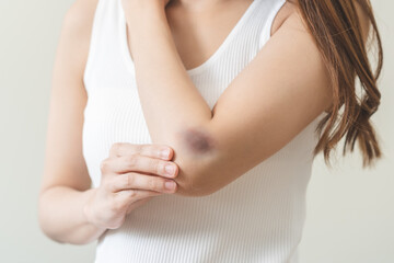 Close up of stain bruise wound on arm, contusion asian young woman, girl an accident fell down stairs, hand on elbow in healing injury by massage hematoma blood. Extravasation blue, purple on skin.