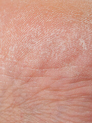 Dry skin damaged macro shot of the surface