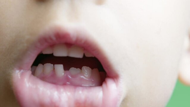 Close up, boy opens his mouth and shows his milky teeth. One missing tooth replaced with permanent toot. High quality 4k footage