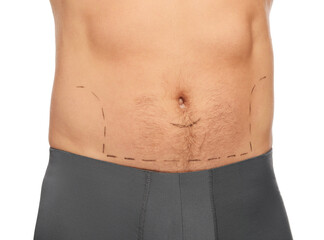 Fototapeta na wymiar Man with markings on belly before cosmetic surgery operation on white background, closeup