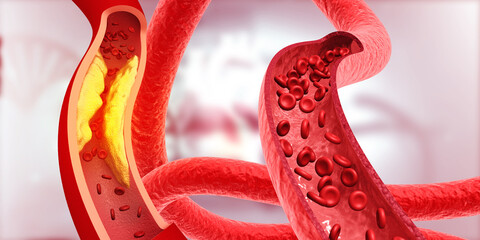 Clogged arteries on scientific background. 3d illustration.