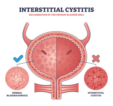 Interstitial cystitis as urinary bladder wall inflammation outline diagram. Labeled educational urology problem and compared healthy bladder surface with inflamed condition vector illustration.