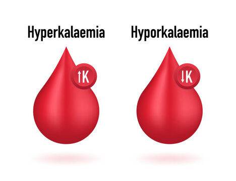 Hyperkalaemia, high plasma potassium level and Hypokalaemia, low plasma potassium level. Potassium K excess and deficit electrolyte disorders, blood test. Vector illustration