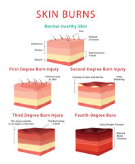 Skin burn classification infographic medical educational scheme poster isometric vector illustration - obrazy, fototapety, plakaty