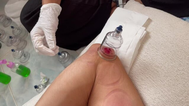 Close up on doctor with latex gloves applying wet cupping therapy with suction gun on patient elbow and blood coming out of skin. Alternative medicine, ancient Chinese pain healing method concepts