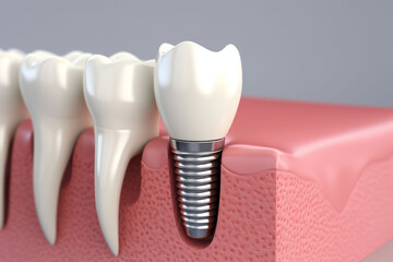 Beautiful white teeth in the row of teeth and one tooth with an implant screw. Dental implant process banner. Copy space