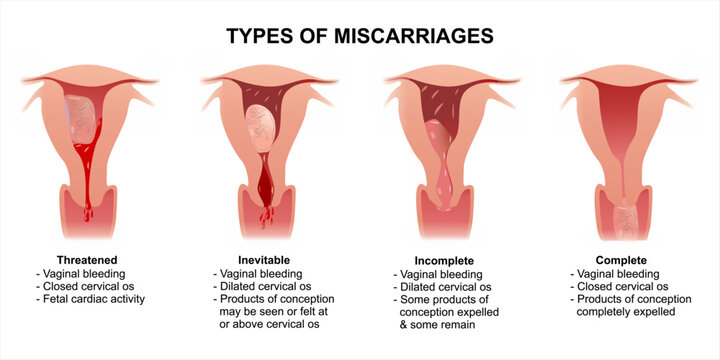 Early pregnancy miscarriage types illustration