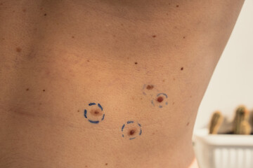 Doctor in medical gloves paint lines around male birthmarks. Preparing procedure for medical...