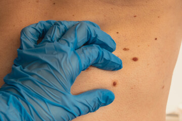 Doctor in medical gloves examining man skin mole. Dermatologist checking male birthmarks. Self care...