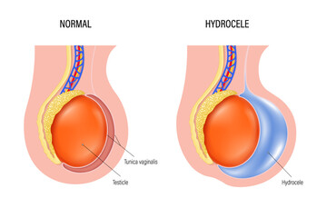 Hydrocele is a swelling of the scrotum. Fluid accumulates in cavity that surrounds testicles. Testicular disease. male reproductive system.