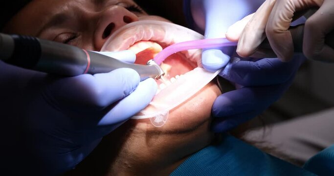 Dentist prepares teeth for installation of veneers and crowns using drill. Replacement of veneers