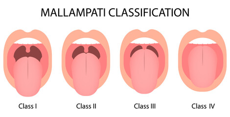 Mallampati Classification score. Oral airway intubation. Medical procedure vector illustration isolated on white background