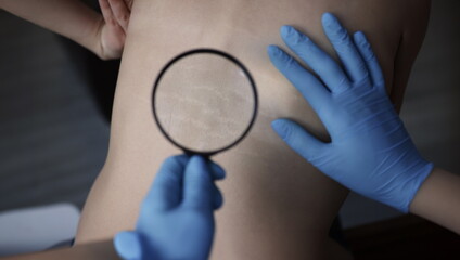 Doctor examining stretch marks on patients back using magnifying glass closeup. Hormonal disorders...