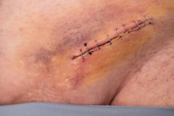 Nine staples to the groin scar on the body of an elderly gentleman after an inguinal hernia...