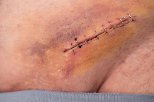 Nine staples to the groin scar on the body of an elderly gentleman after an inguinal hernia operation