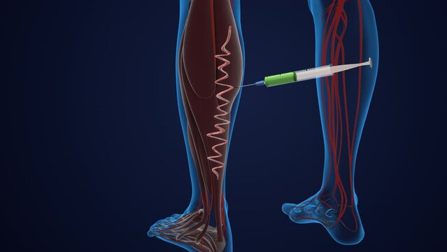 Treatment for varicose and spider veins with sclerotherapy